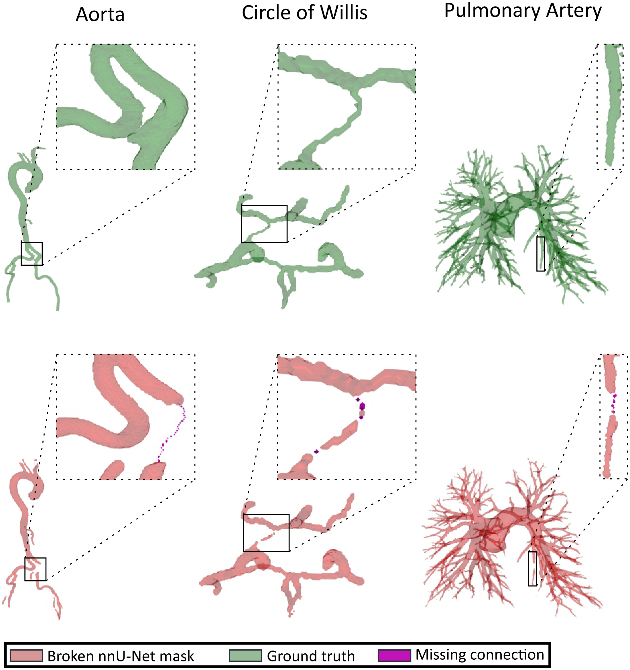 Reference vessel structures (top) and broken nnU-Net predictions (bottom) for the aorta, Circle of Willis and pulmonary arteries, with missing connections highlighted.