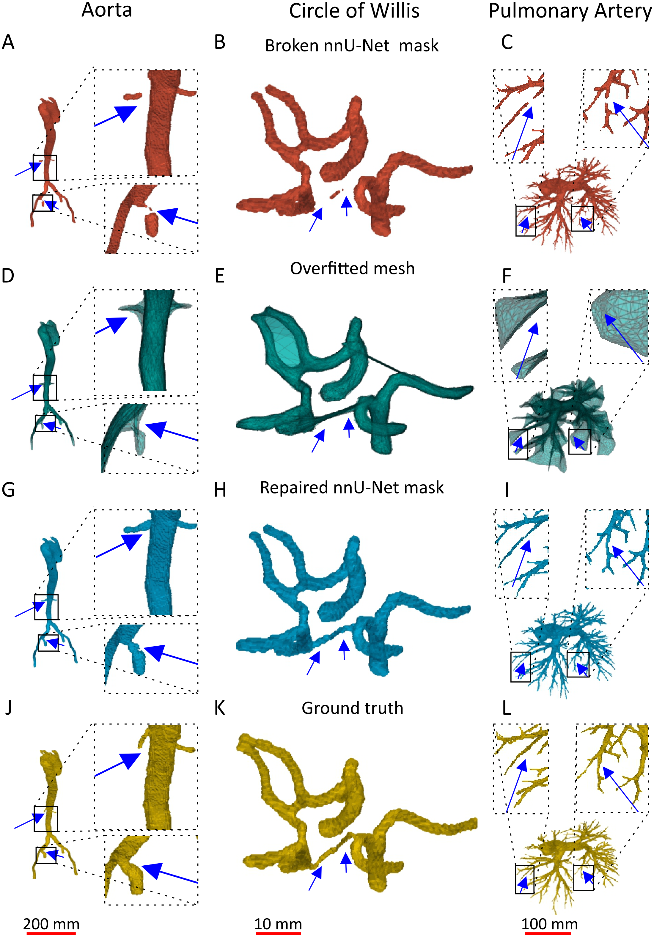 Qualitative examples for aorta, Circle of Willis and pulmonary artery: broken mask, overfitted mesh, repaired mask and ground truth.